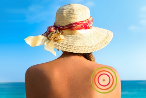 What Is Melanoma?